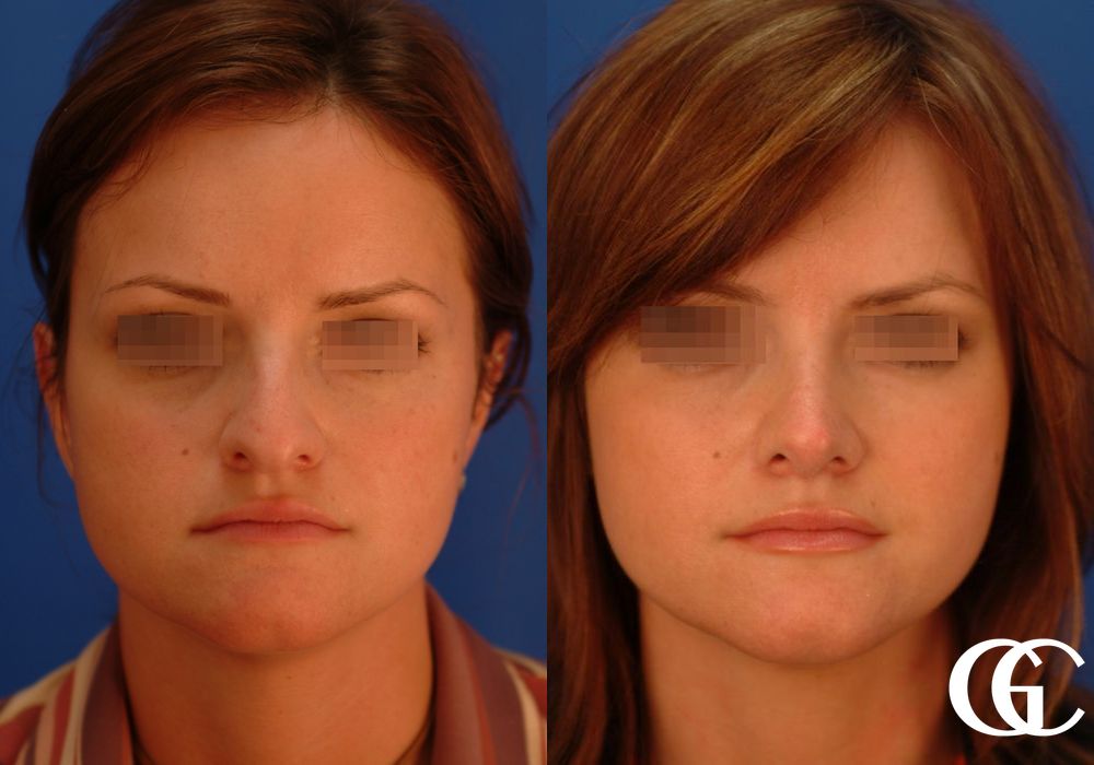 Bader Rhinoplasty Rhinoplasty Archives - The Geldner Center