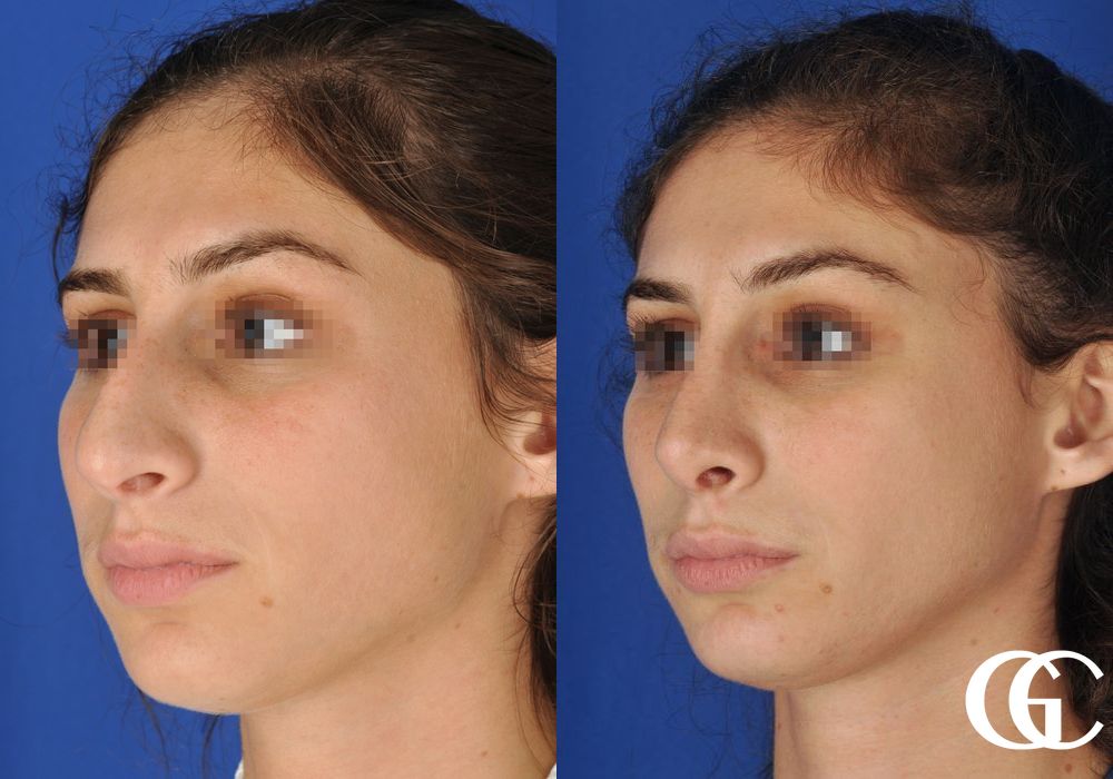 Rhinoplasty - Thumbnail 4