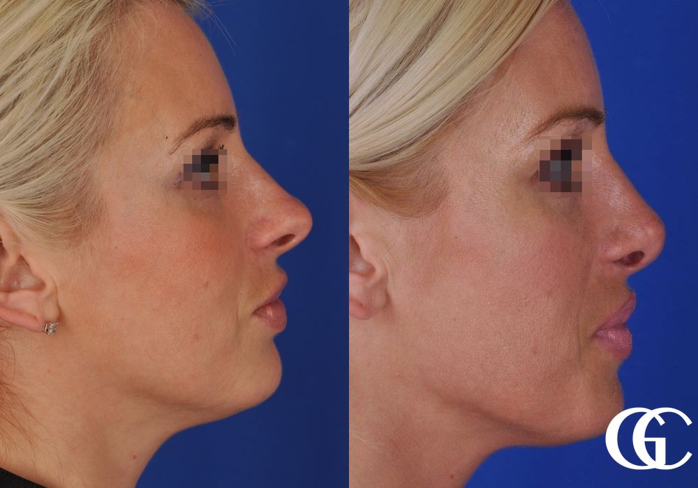 Rhinoplasty - Thumbnail 3