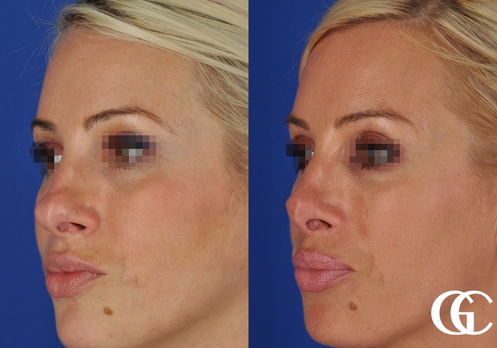 Rhinoplasty - Thumbnail 4