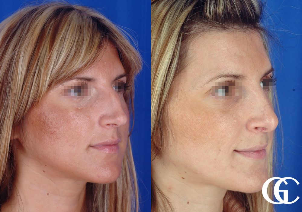 Rhinoplasty - Thumbnail 2