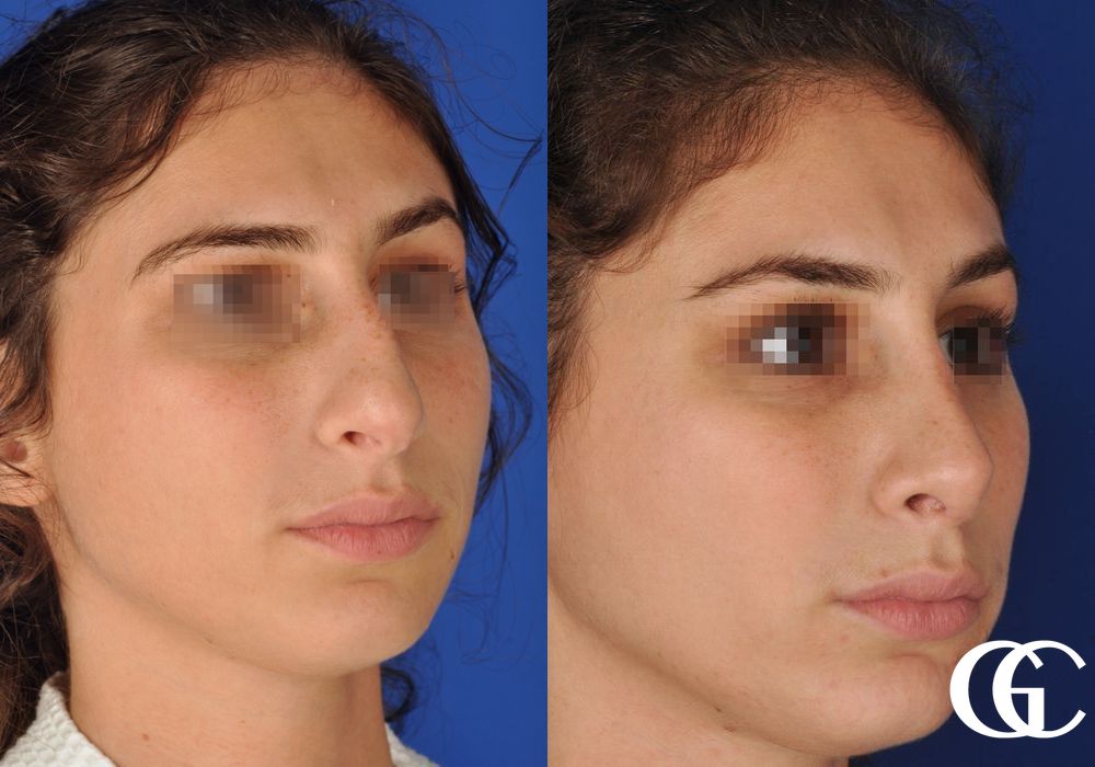 Rhinoplasty - Thumbnail 2