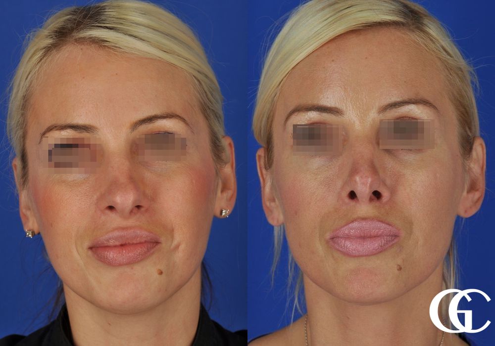 Rhinoplasty - Case 7427