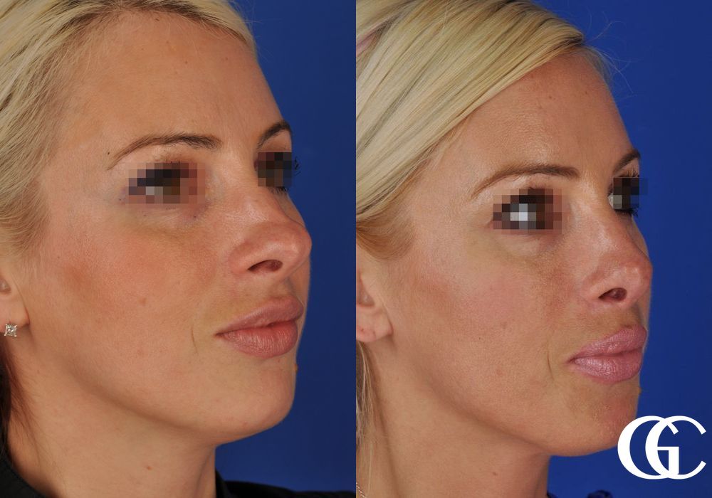 Rhinoplasty - Thumbnail 2