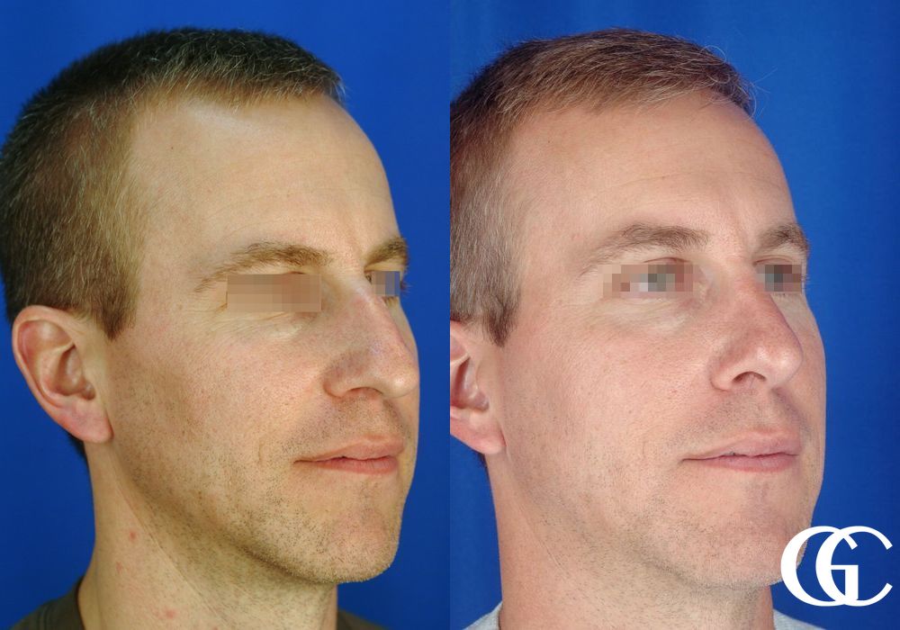 Rhinoplasty for Men - Thumbnail 2