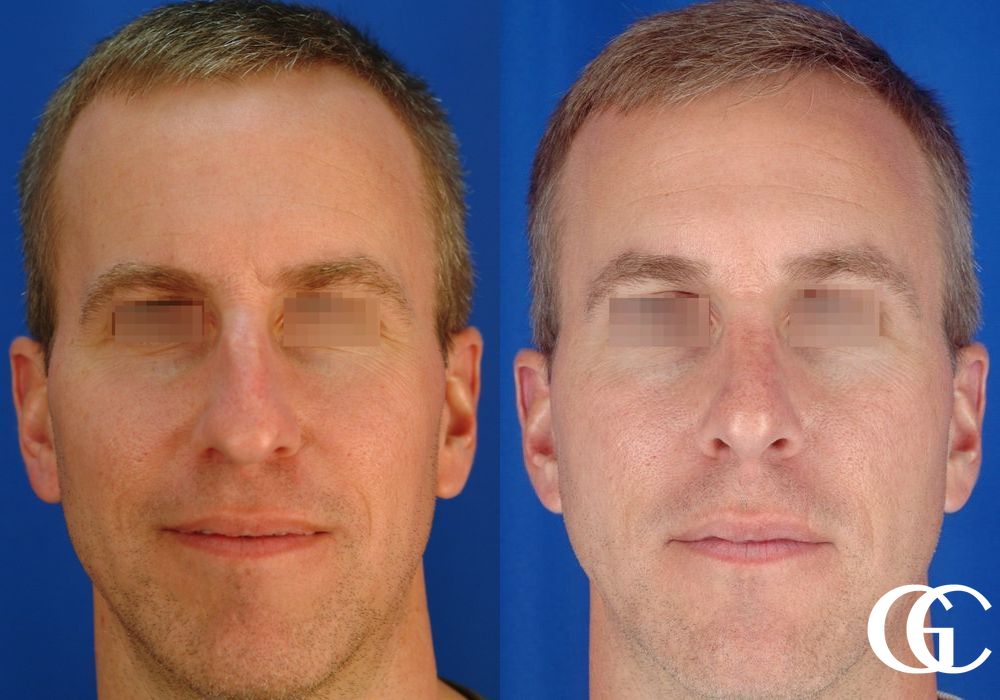 Rhinoplasty for Men - Case 7539