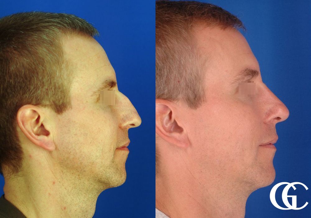 Rhinoplasty for Men - Thumbnail 3