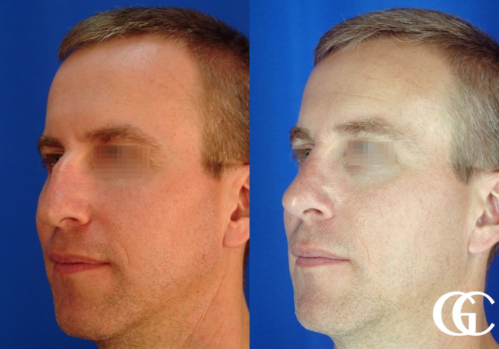 Rhinoplasty for Men - Thumbnail 4