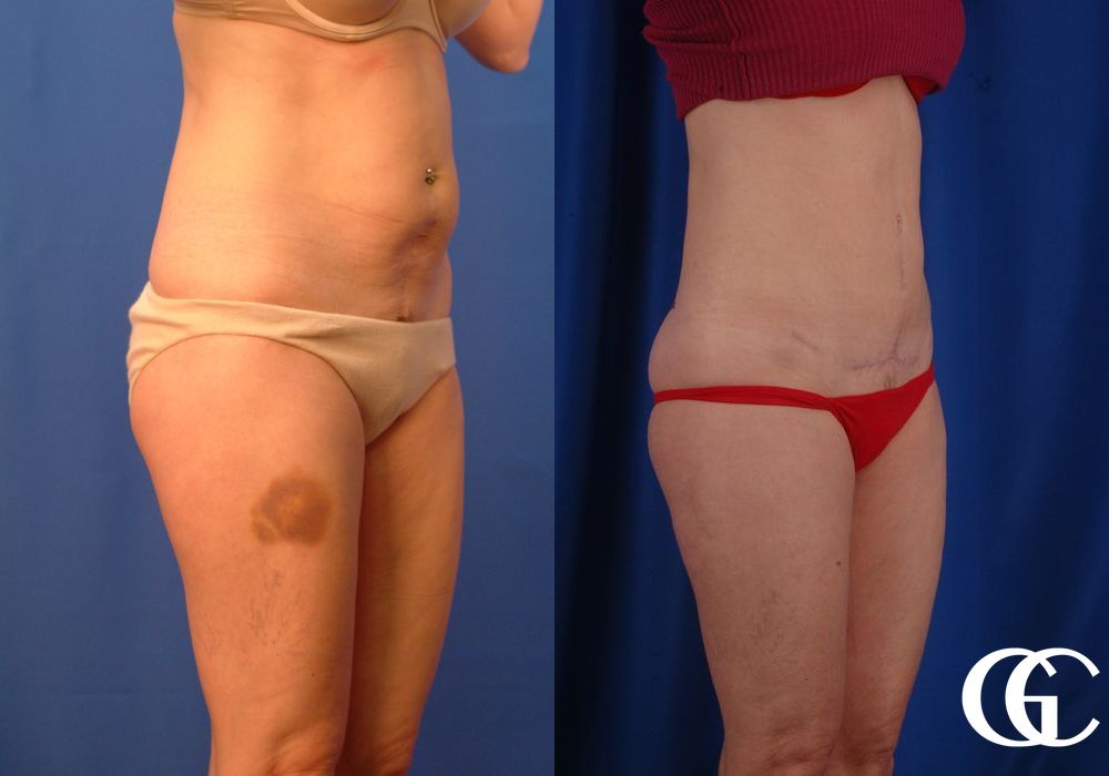 Tummy Tuck - Thumbnail 3