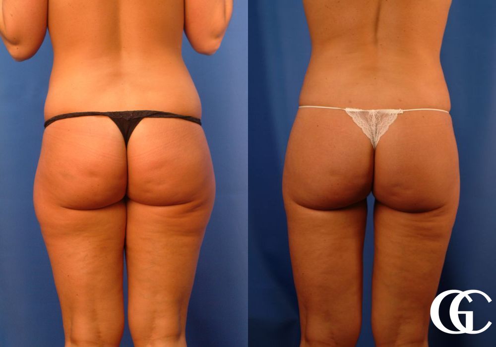 Tummy Tuck - Thumbnail 5