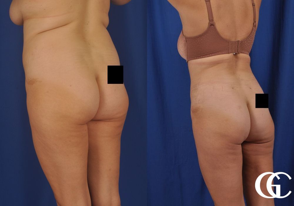 Tummy Tuck - Thumbnail 4