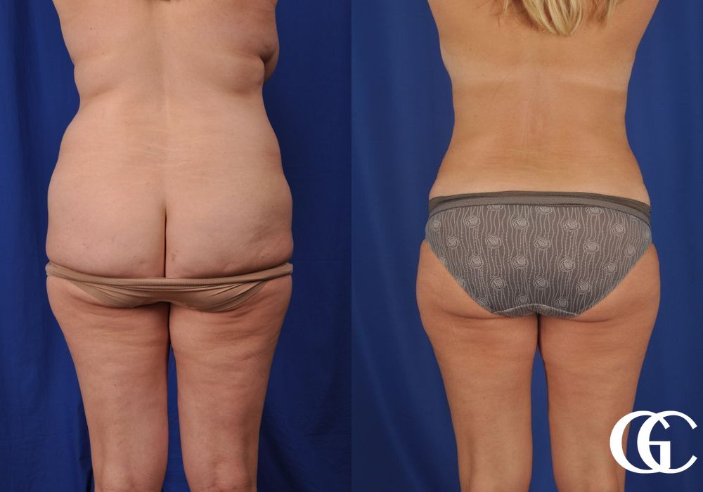 Tummy Tuck - Thumbnail 5