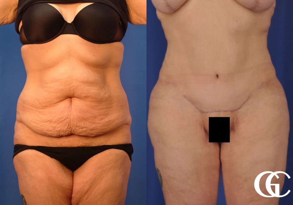 Tummy Tuck - Case 7005