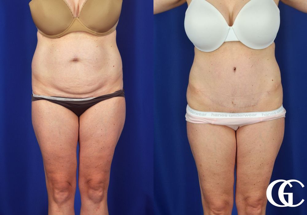 Tummy Tuck - Case 6993