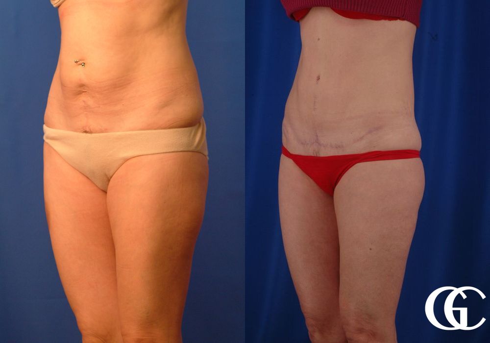 Tummy Tuck - Thumbnail 2