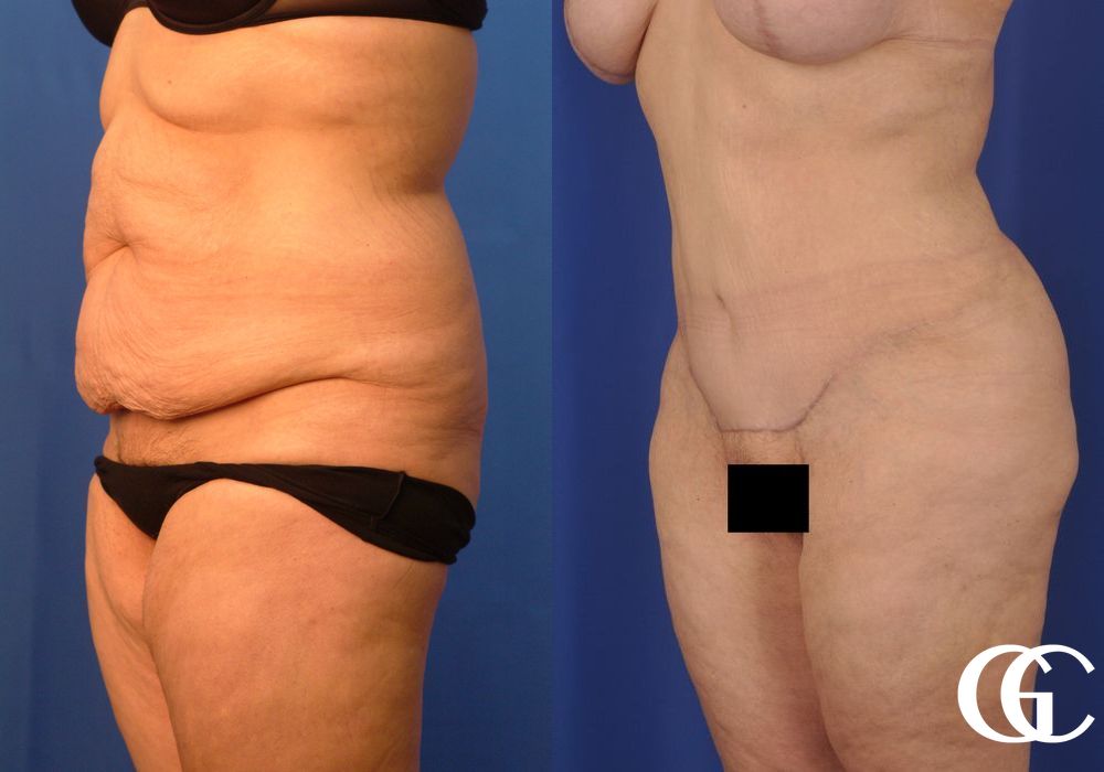 Tummy Tuck - Thumbnail 4