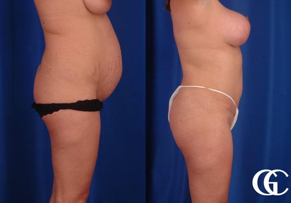 Tummy Tuck - Thumbnail 2