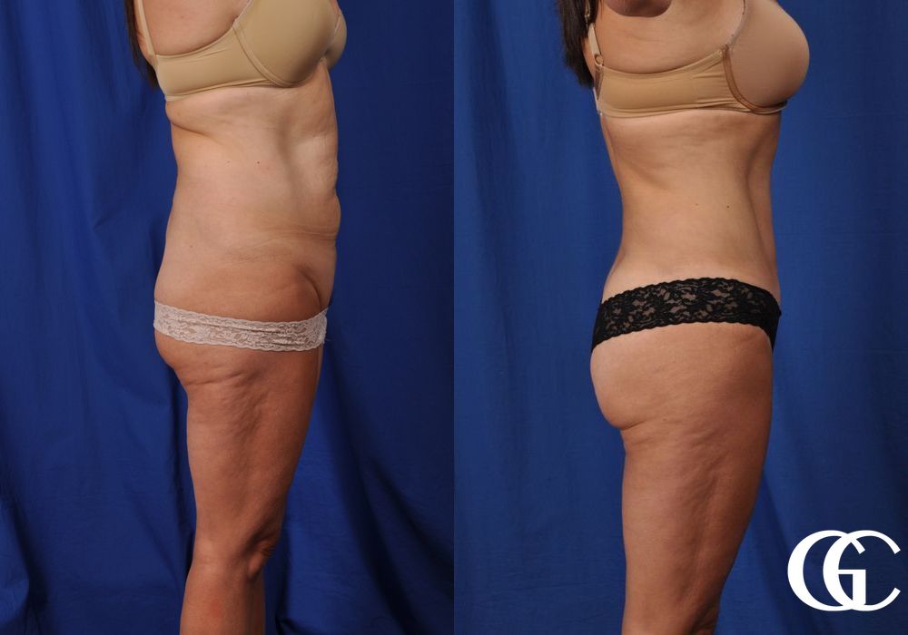 Tummy Tuck - Thumbnail 2