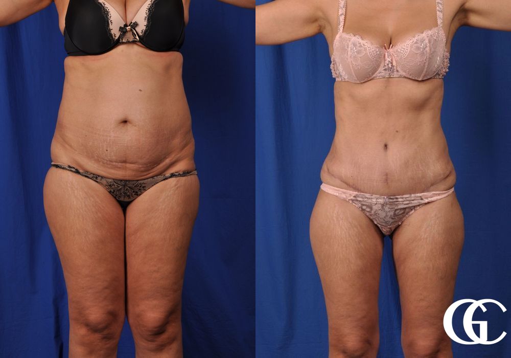 Tummy Tuck - Case 7007