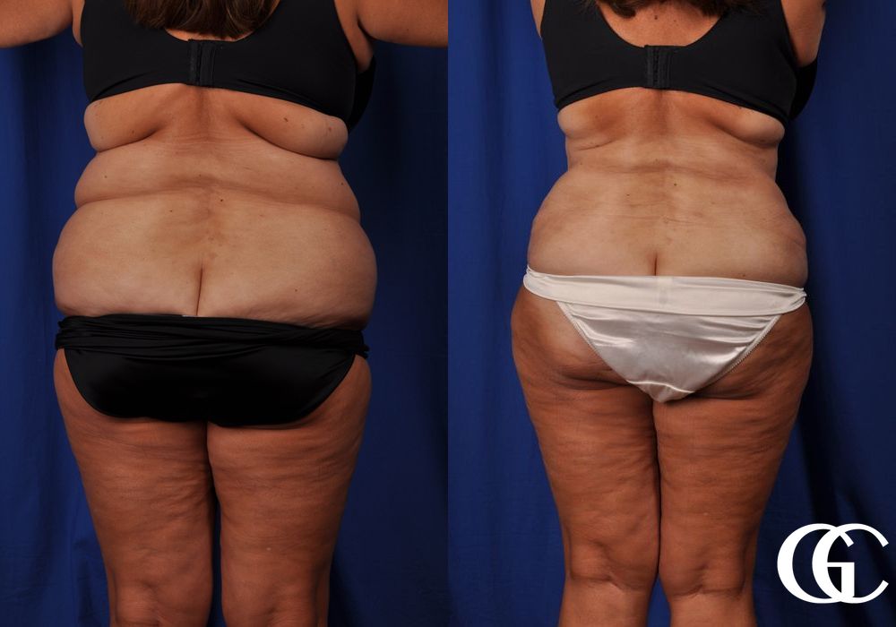 Tummy Tuck - Thumbnail 4