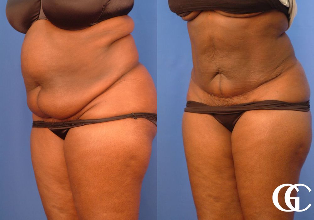 Tummy Tuck - Thumbnail 5