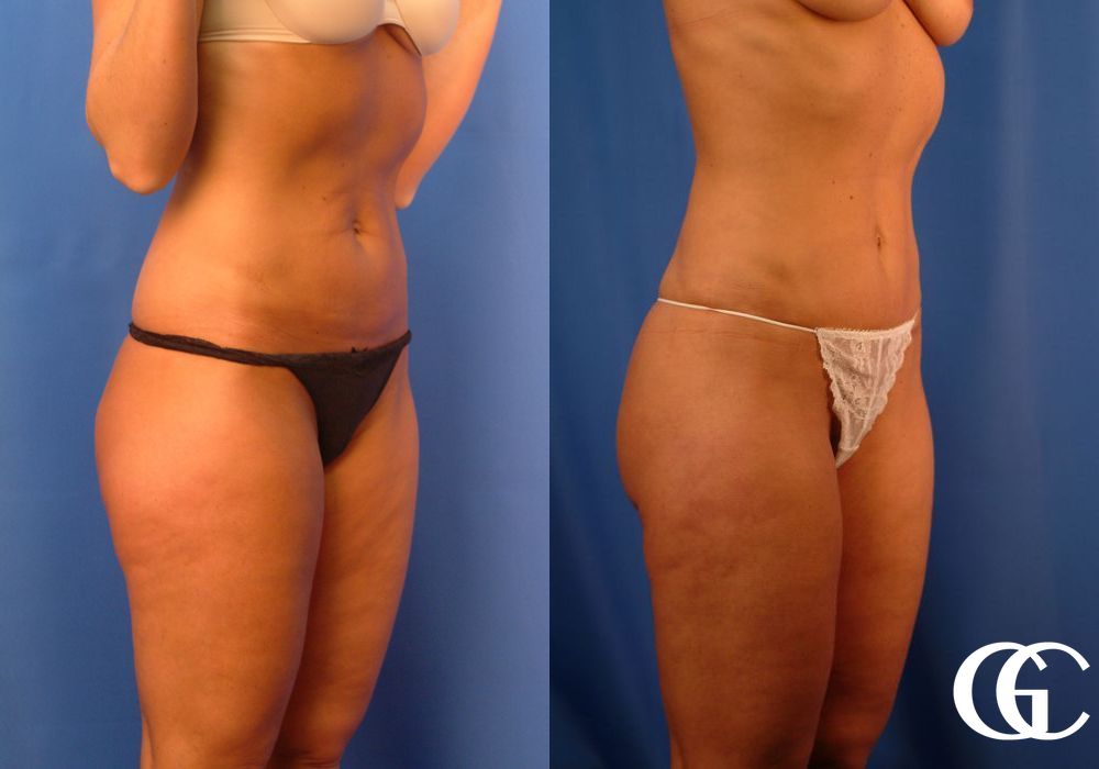 Tummy Tuck - Thumbnail 2