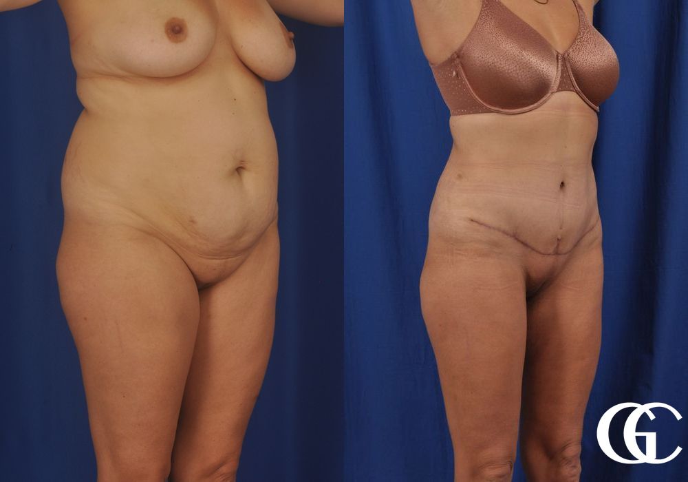 Tummy Tuck - Thumbnail 2