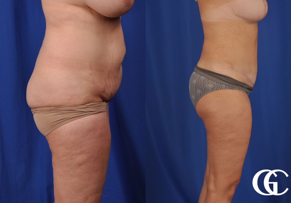 Tummy Tuck - Thumbnail 2