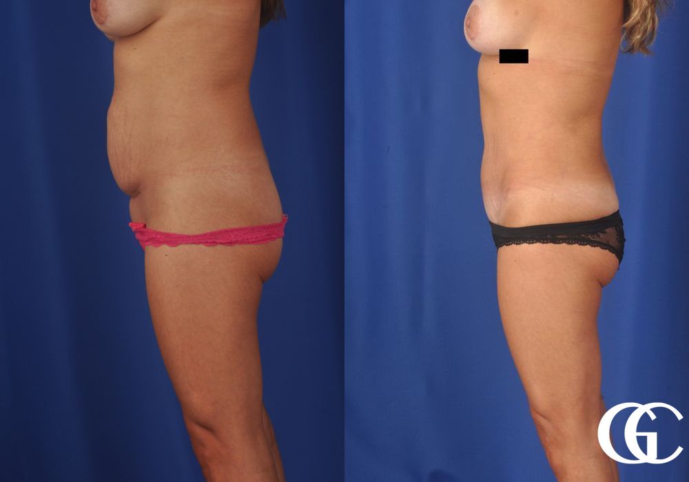 Tummy Tuck - Thumbnail 3