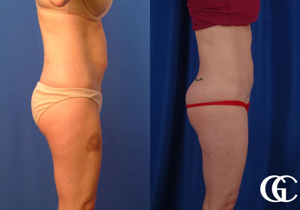 Tummy Tuck - Thumbnail 4