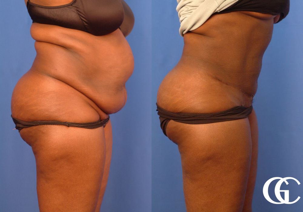 Tummy Tuck - Thumbnail 3