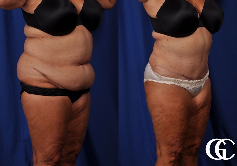 Tummy Tuck - Thumbnail 2