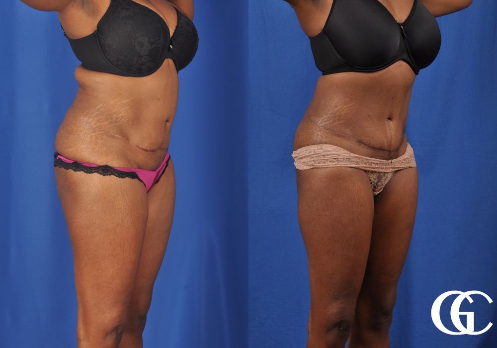 Tummy Tuck - Thumbnail 2