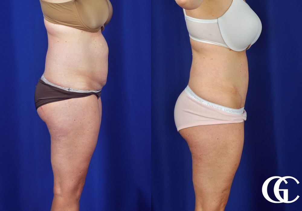 Tummy Tuck - Thumbnail 3