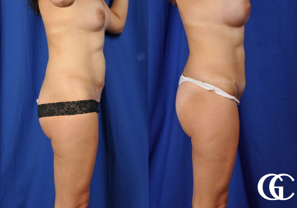 Tummy Tuck - Thumbnail 3