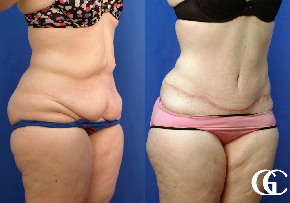 Tummy Tuck - Thumbnail 2