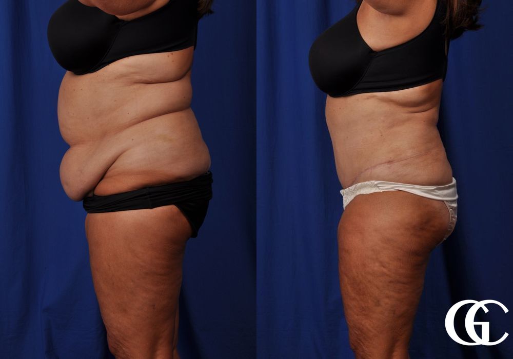 Tummy Tuck - Thumbnail 3