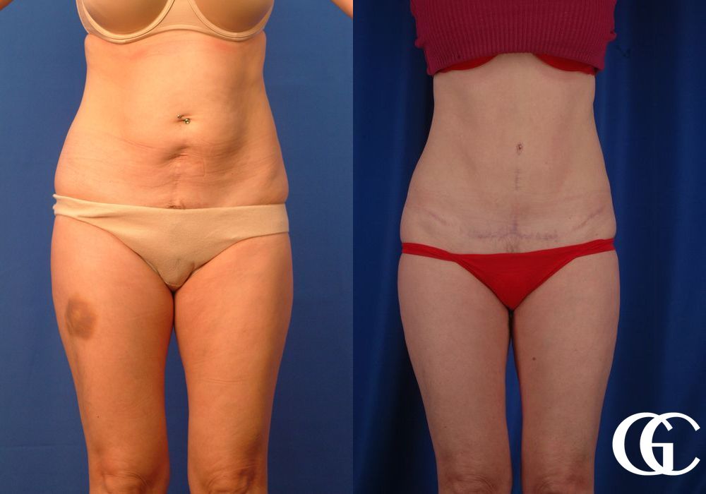 Tummy Tuck - Case 7021