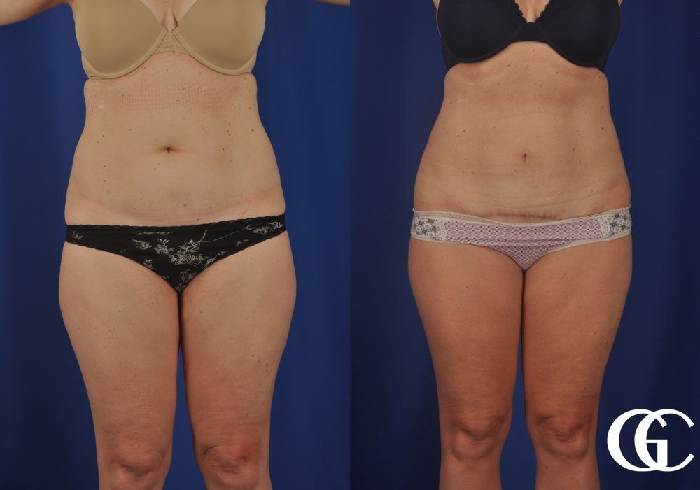 Tummy Tuck - Case 7008