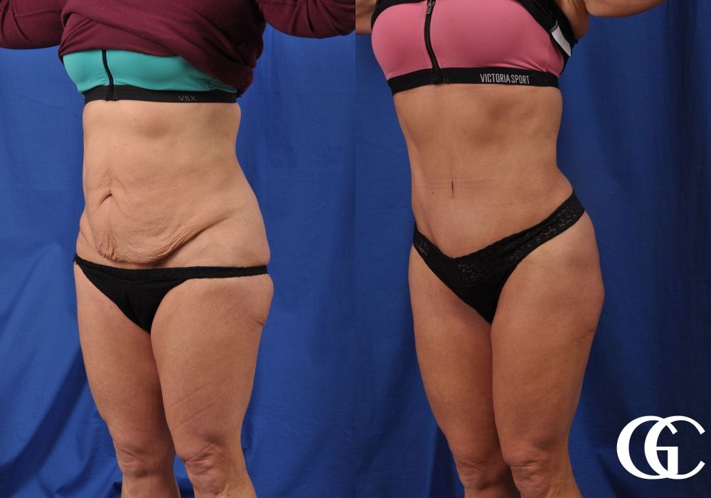 Tummy Tuck - Thumbnail 4