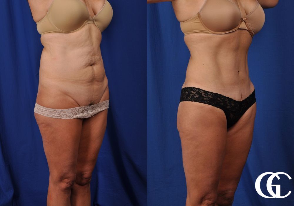 Tummy Tuck - Thumbnail 4