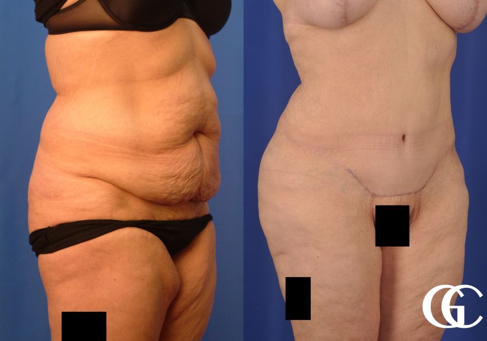 Tummy Tuck - Thumbnail 2