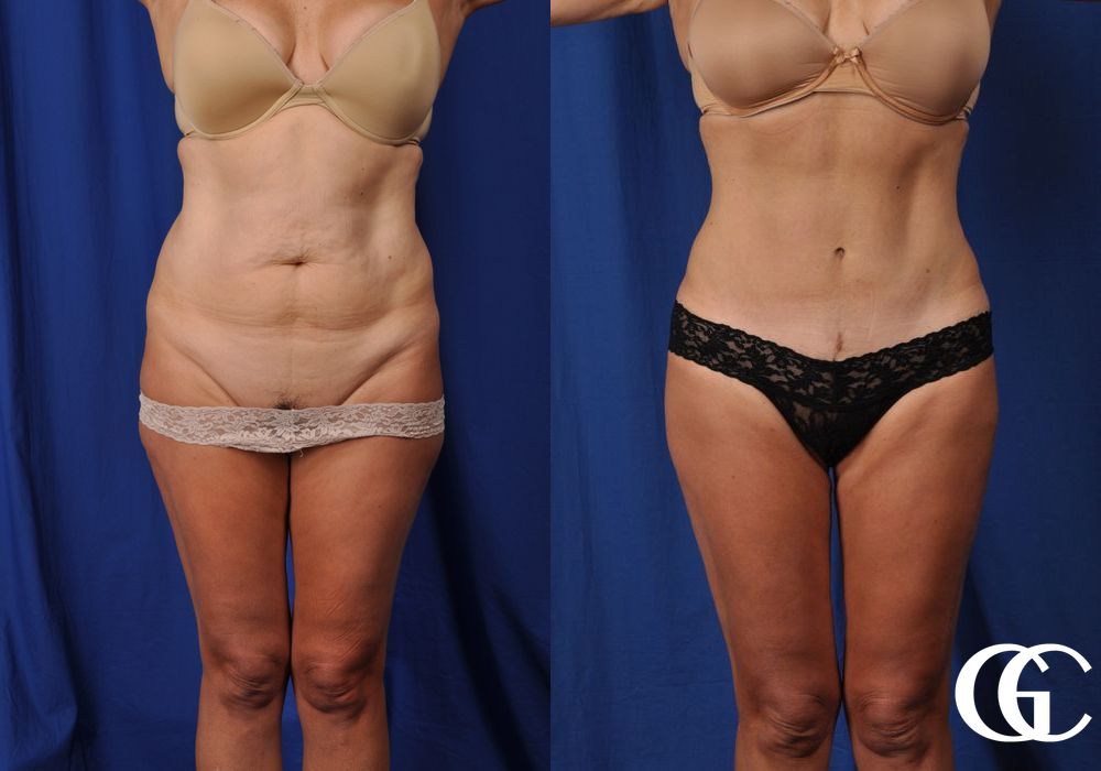 Tummy Tuck - Case 7020