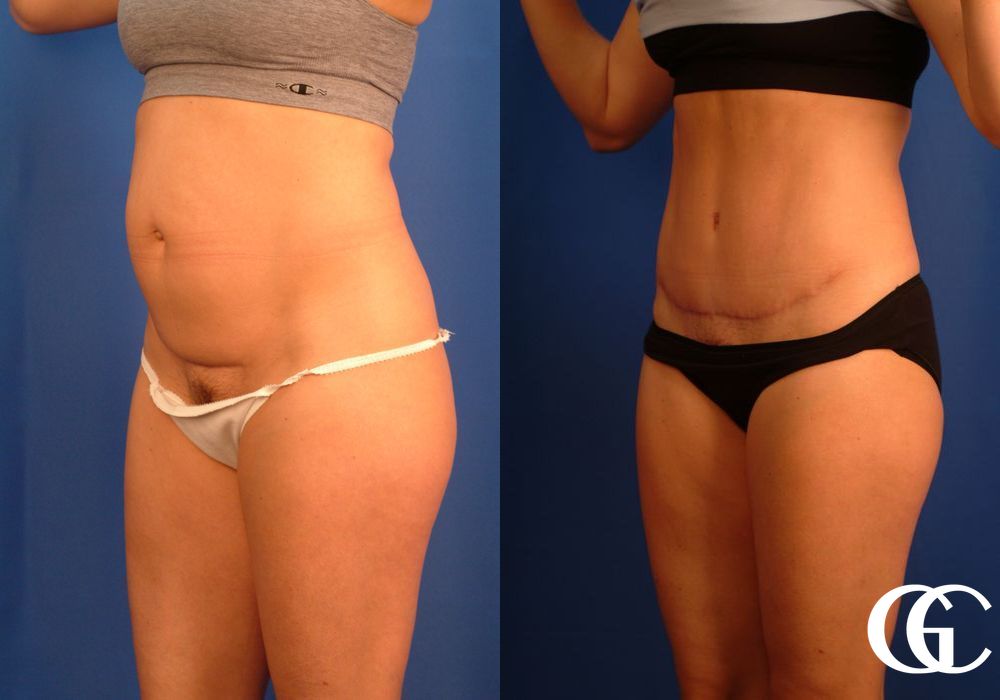 Tummy Tuck - Thumbnail 4