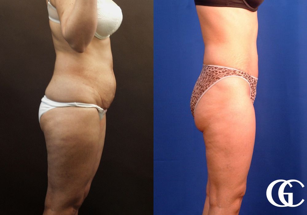 Tummy Tuck - Thumbnail 3