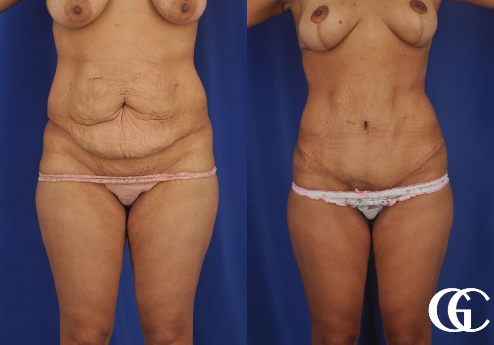 Tummy Tuck - Case 7018