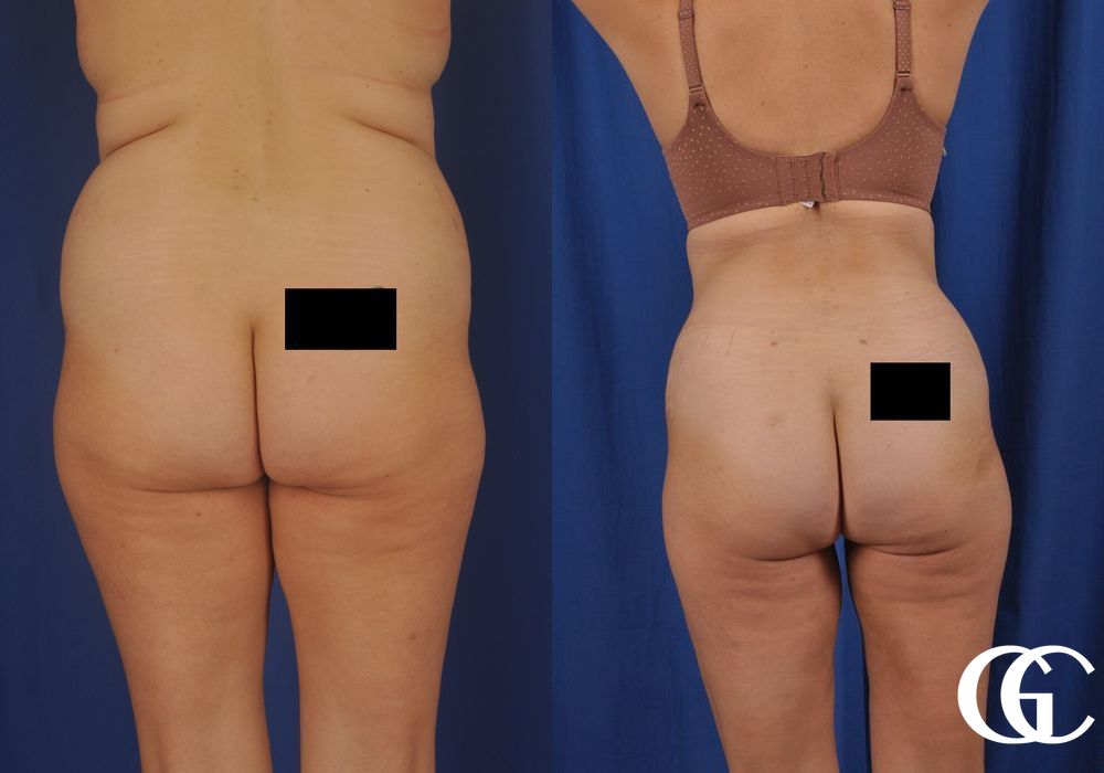 Tummy Tuck - Thumbnail 5