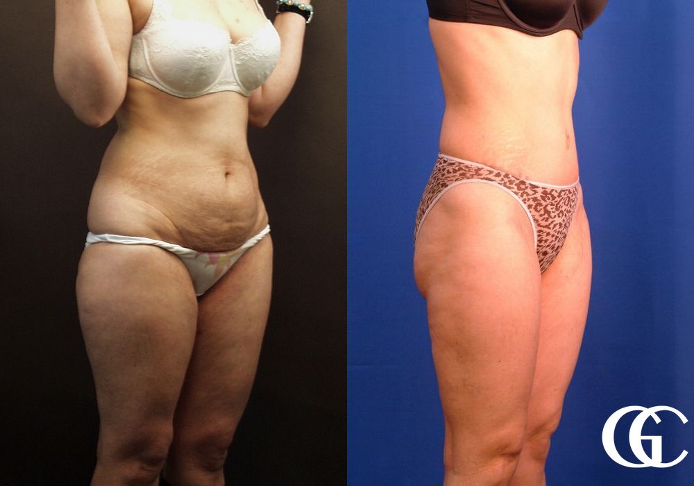 Tummy Tuck - Thumbnail 2