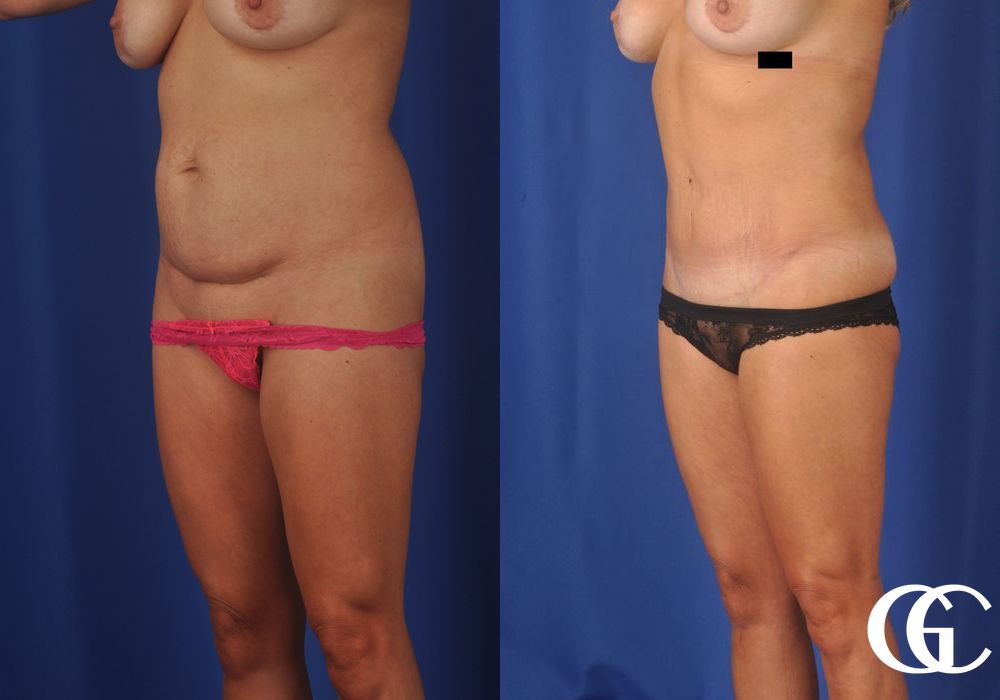 Tummy Tuck - Thumbnail 2