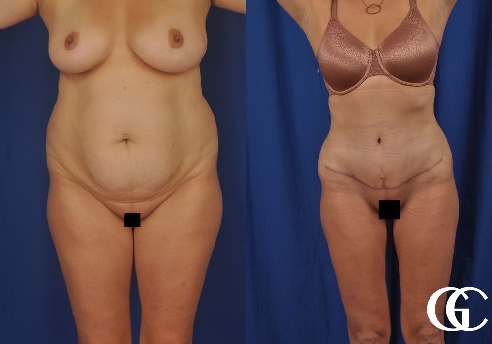Tummy Tuck - Case 7022